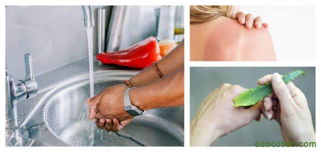 remedios caseros para quemaduras