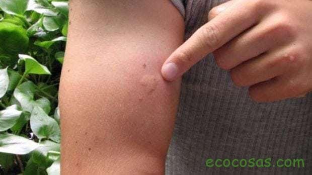 Remedios naturales para aliviar y prevenir las picaduras de mosquitos 1 remedios para las picaduras de insectos
