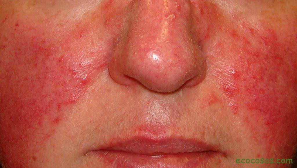 rosacea