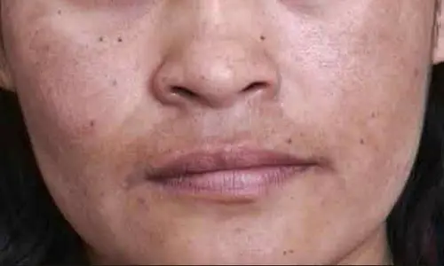 eliminar melasma definitivamente