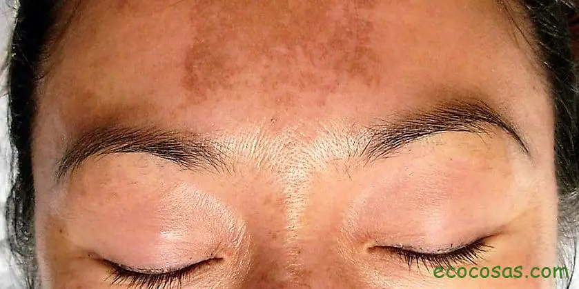 melasma