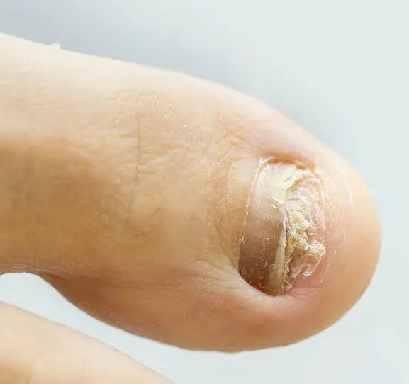 remedios caseros para los hongos en las uñas